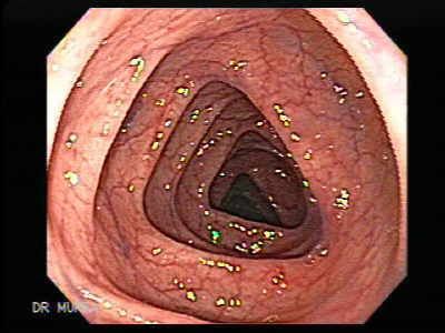 Colonoscopy2.jpg