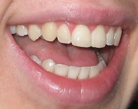 retainer wear mouth possible too much retainers assume usually common their