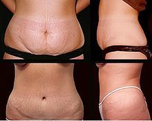 tummy tuck procedure