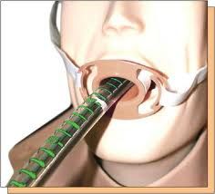endoscopic weight loss surgery