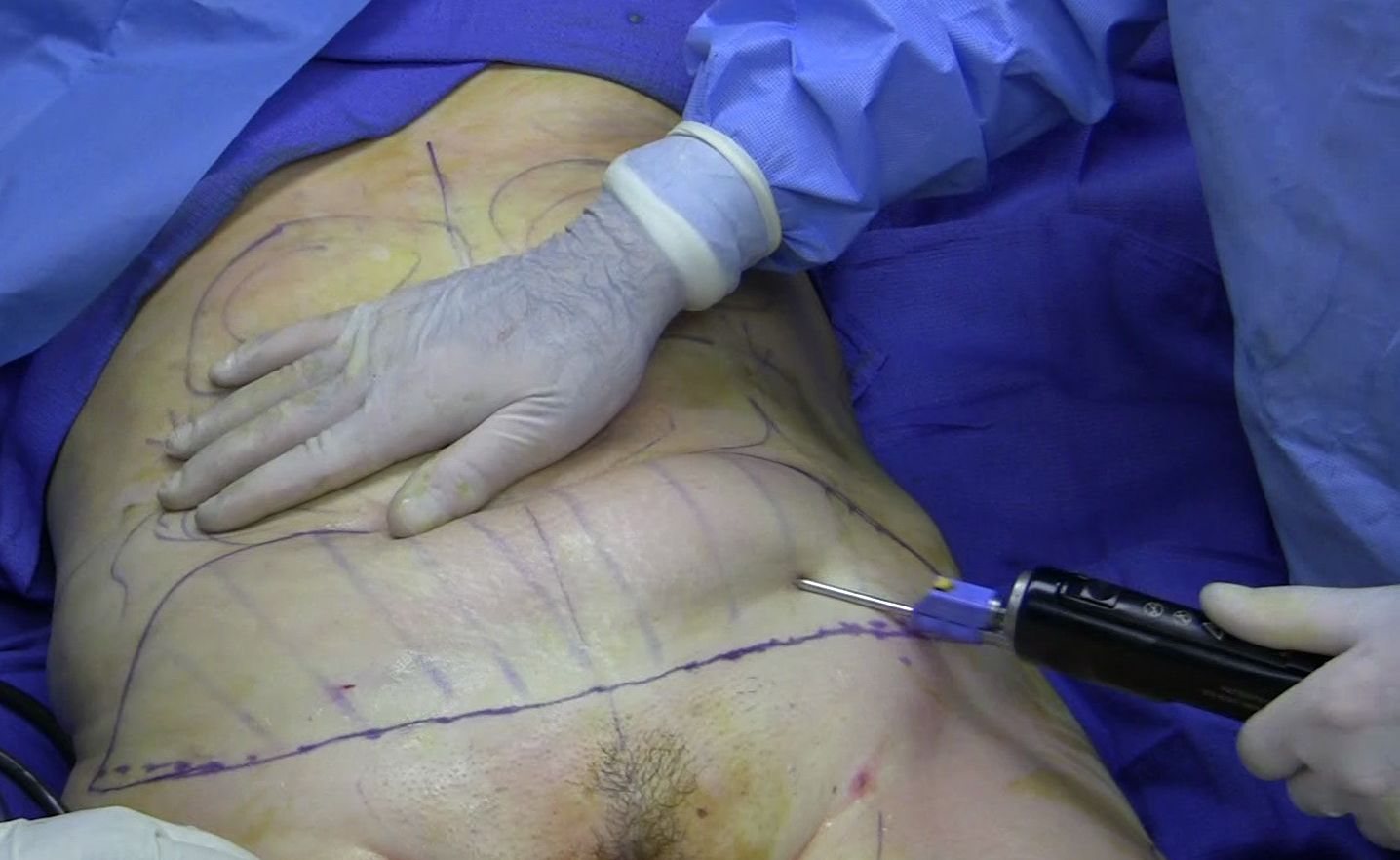 liposuction procedure