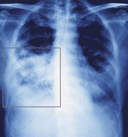 viral lung infection